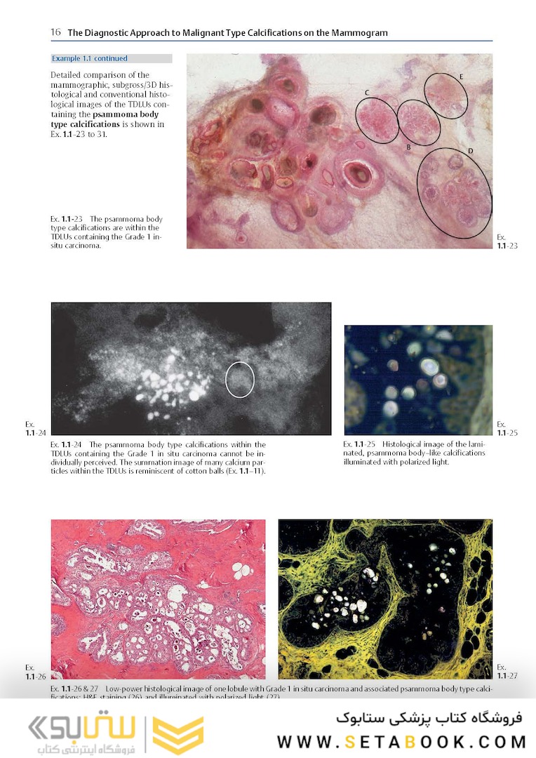 Breast Cancer: Early Detection with Mammography: Crushed Stone-like Calcifications: The Most Frequent Malignant Type 1st Edicion 2008