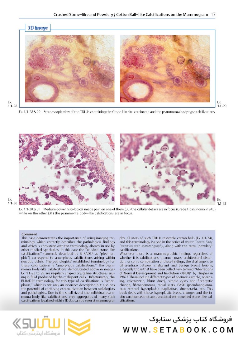 Breast Cancer: Early Detection with Mammography: Crushed Stone-like Calcifications: The Most Frequent Malignant Type 1st Edicion 2008