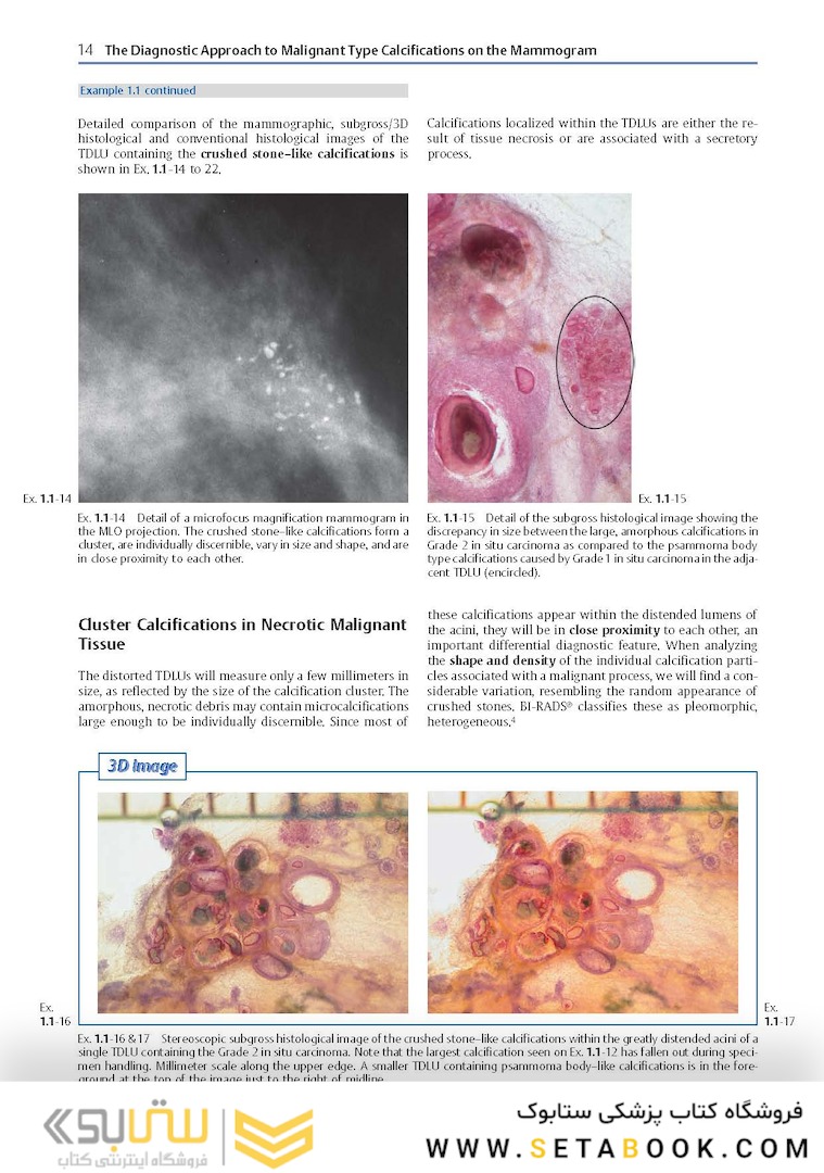 Breast Cancer: Early Detection with Mammography: Crushed Stone-like Calcifications: The Most Frequent Malignant Type 1st Edicion 2008