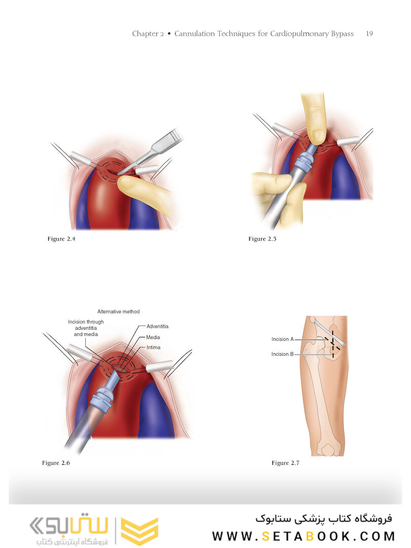 Atlas of Cardiac Surgical Techniques 2nd Edition2018