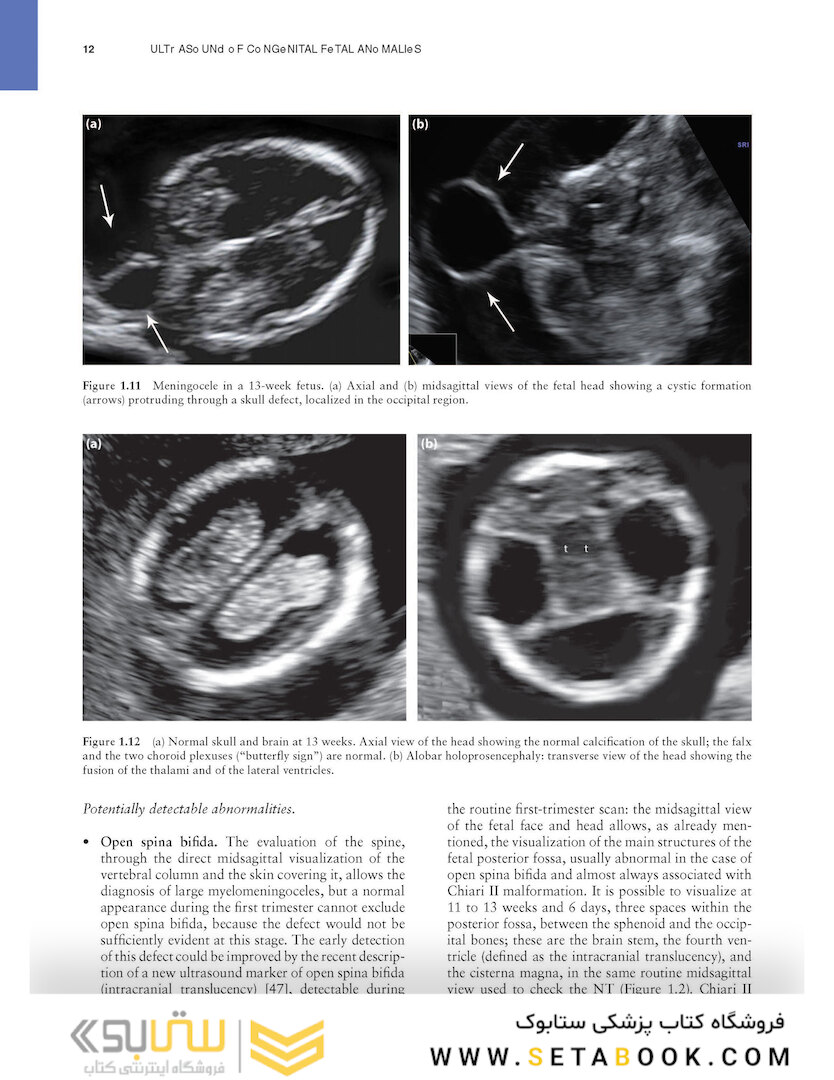 Ultrasound of Congenital Fetal Anomalies 2nd Edition2014