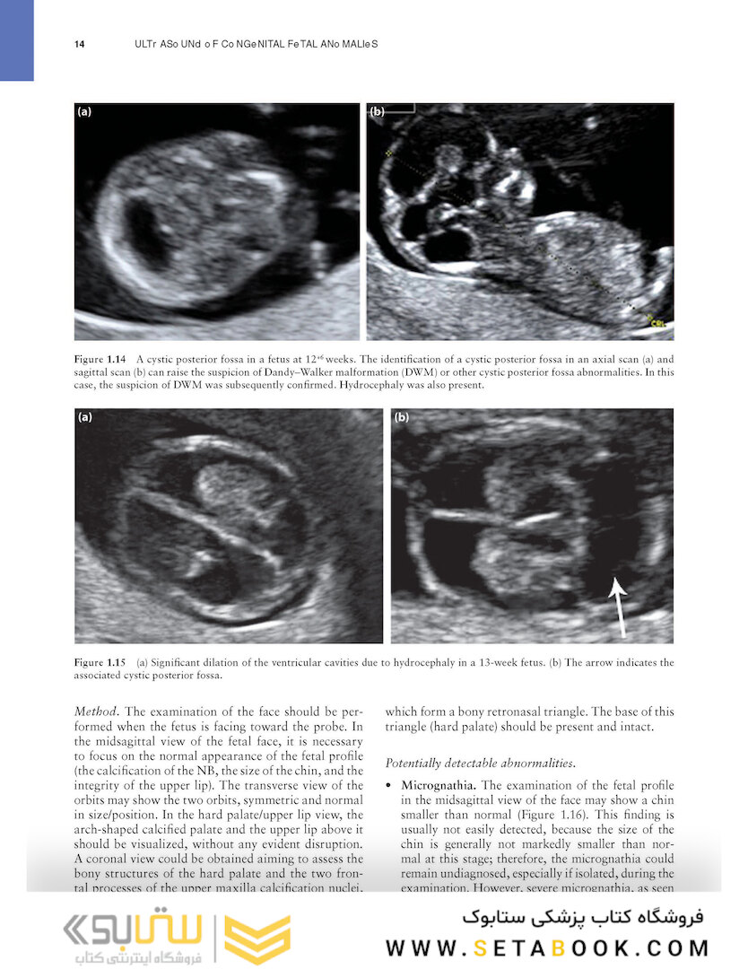 Ultrasound of Congenital Fetal Anomalies 2nd Edition2014