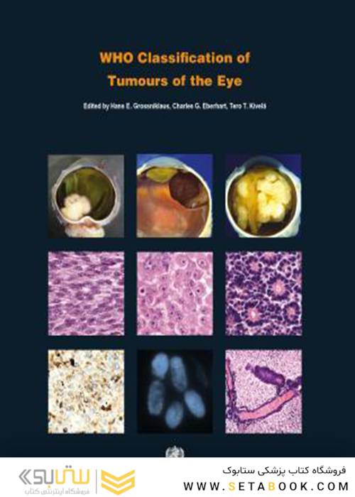 WHO Classification of Tumours of the Eye, 4th Edition2018 طبقه بندی تومورهای چشم
