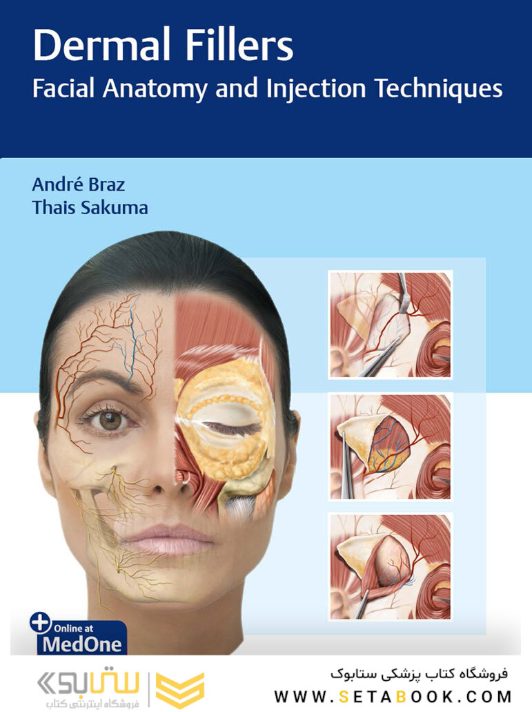 Dermal Fillers: Facial Anatomy and Injection Techniques2020