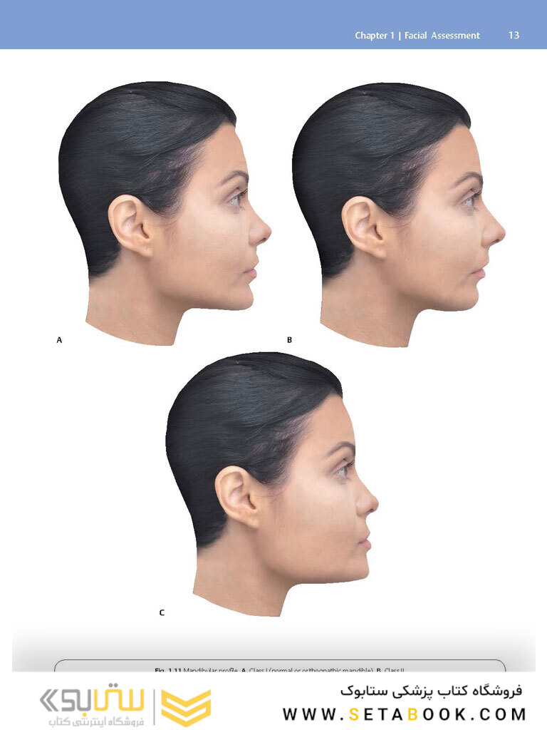 Dermal Fillers: Facial Anatomy and Injection Techniques2020