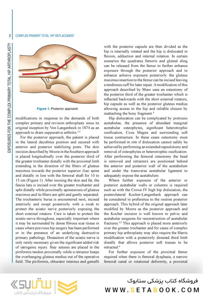 Complex Primary Total Hip Replacement 1st Edition