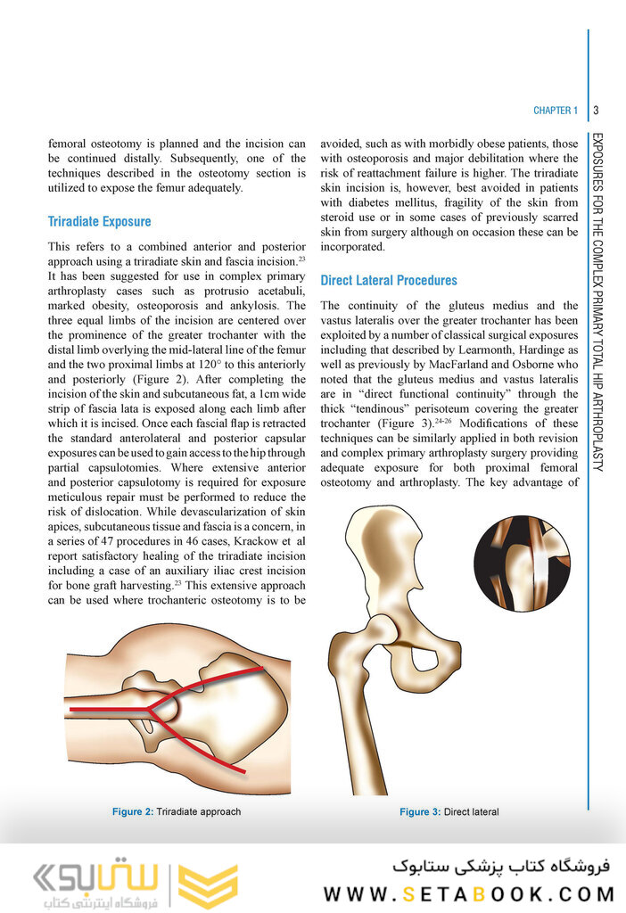Complex Primary Total Hip Replacement 1st Edition