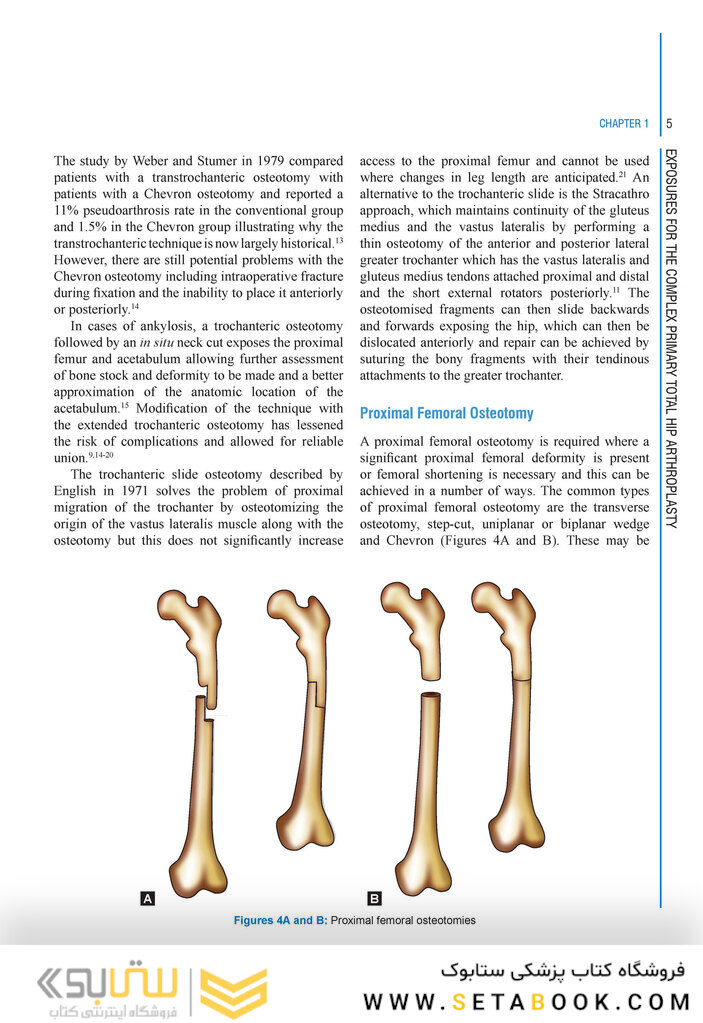 Complex Primary Total Hip Replacement 1st Edition