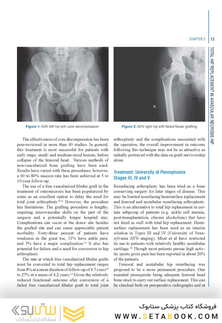 Complex Primary Total Hip Replacement 1st Edition
