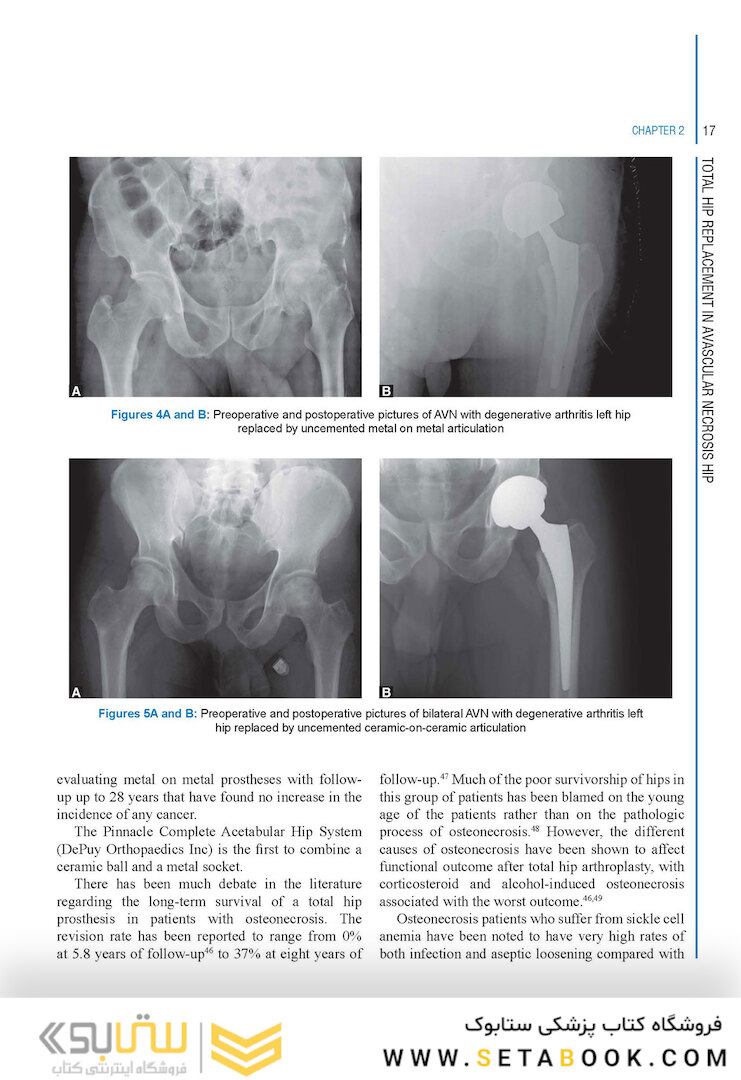 Complex Primary Total Hip Replacement 1st Edition