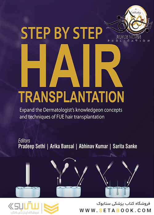 Step by Step Hair Transplantation 2019