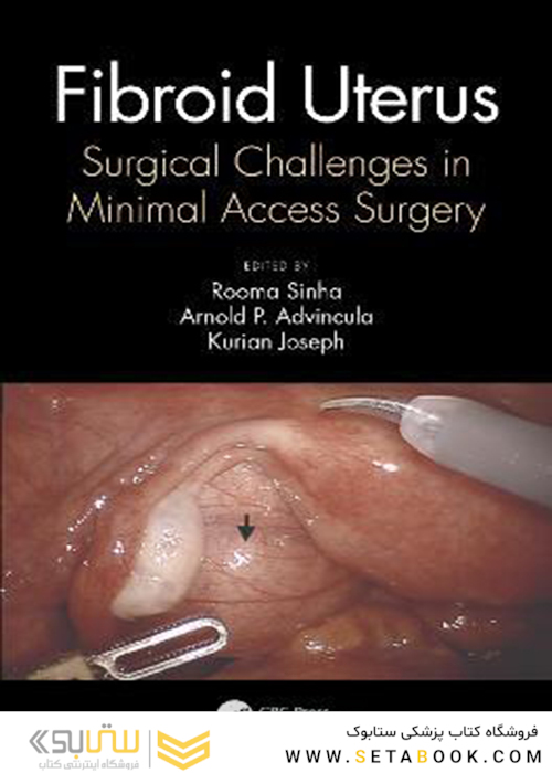 Fibroid Uterus: Surgical Challenges in Minimal Access Surgery2020فیبروئید رحم