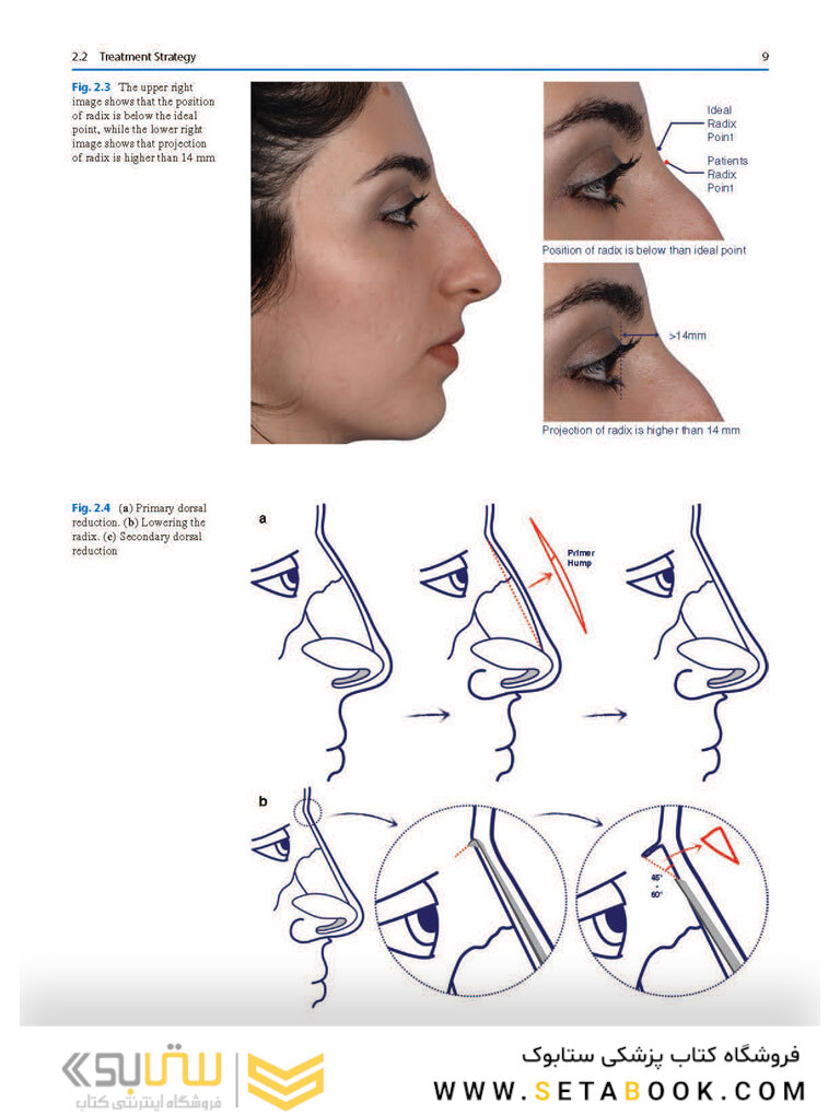 Photographic Atlas of Rhinoplasty : Problem-solving and Troubleshooting