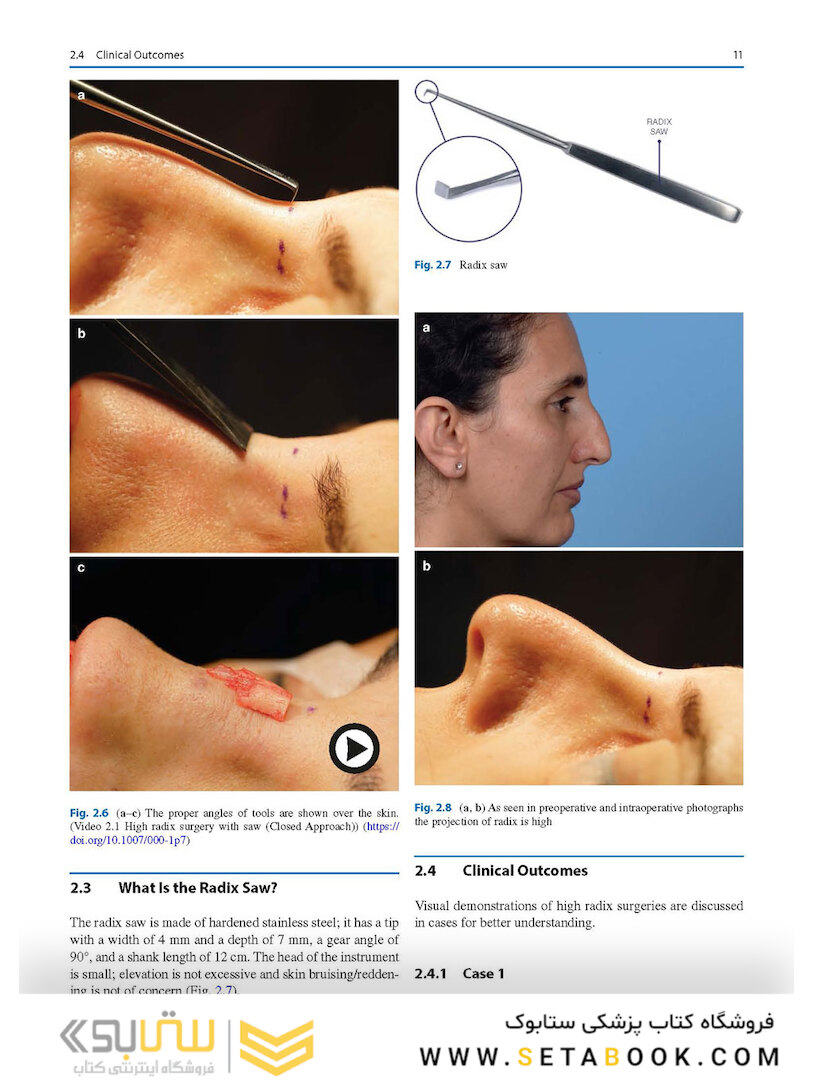 Photographic Atlas of Rhinoplasty : Problem-solving and Troubleshooting
