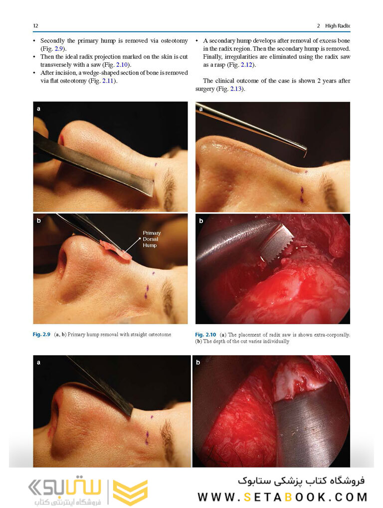 Photographic Atlas of Rhinoplasty : Problem-solving and Troubleshooting