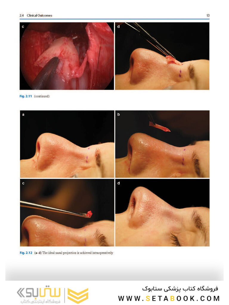 Photographic Atlas of Rhinoplasty : Problem-solving and Troubleshooting