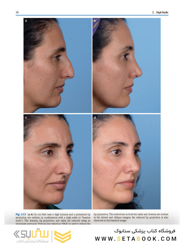 Photographic Atlas of Rhinoplasty : Problem-solving and Troubleshooting