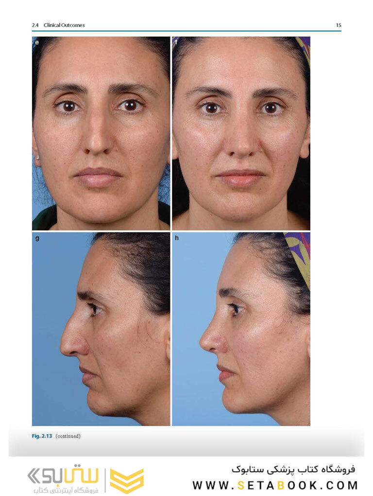 Photographic Atlas of Rhinoplasty : Problem-solving and Troubleshooting