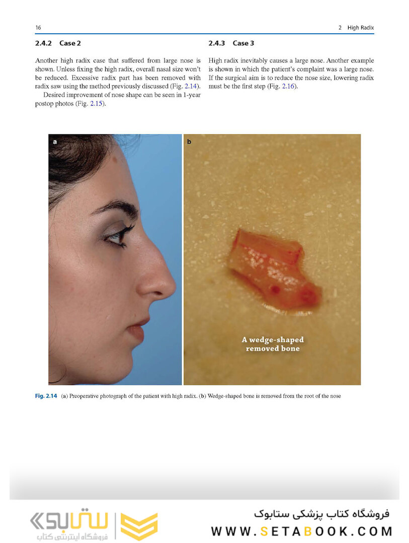 Photographic Atlas of Rhinoplasty : Problem-solving and Troubleshooting