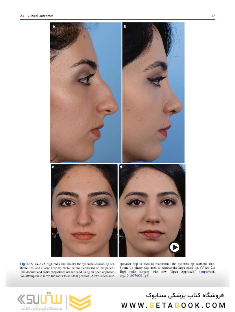 Photographic Atlas of Rhinoplasty : Problem-solving and Troubleshooting