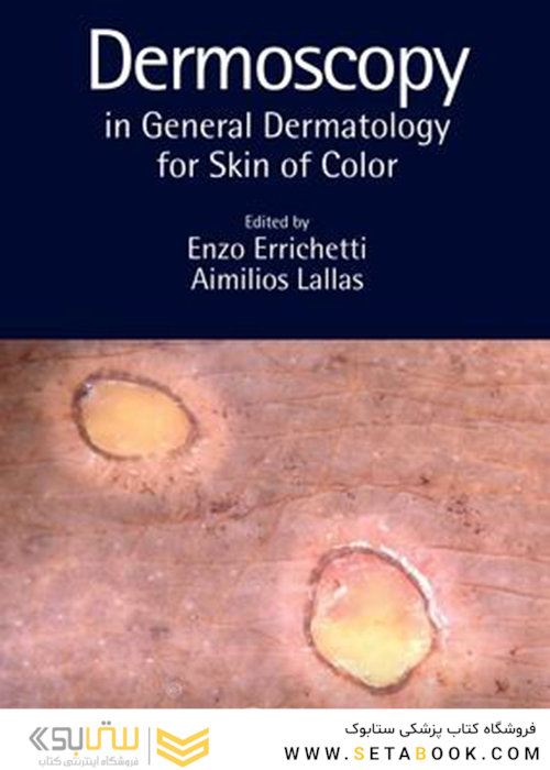 Dermoscopy in General Dermatology for Skin of Color2021