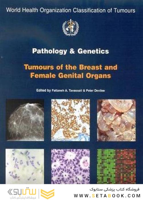 Pathology and Genetics of Tumours of the Breast and Female Genital Organs2003