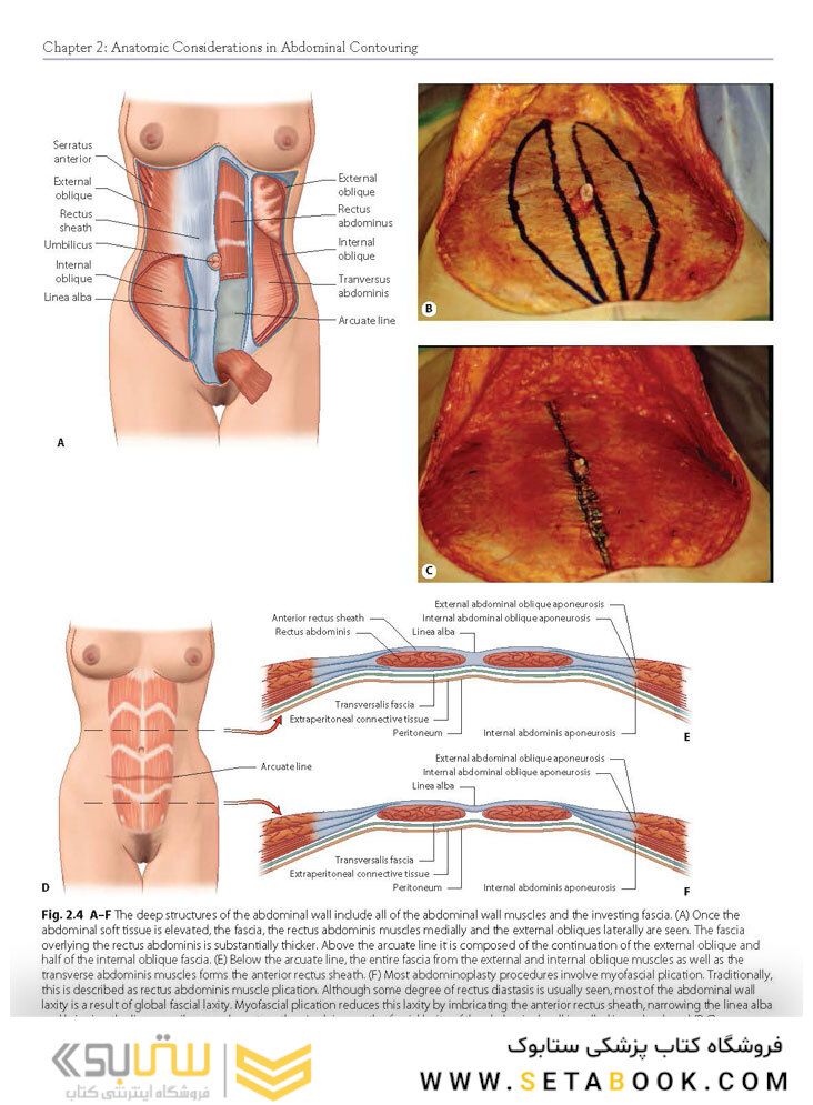 Atlas of Abdominoplasty