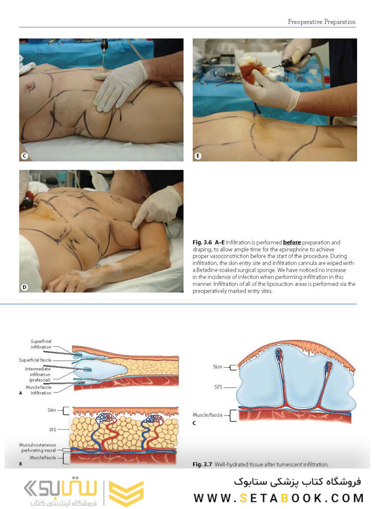 Atlas of Abdominoplasty