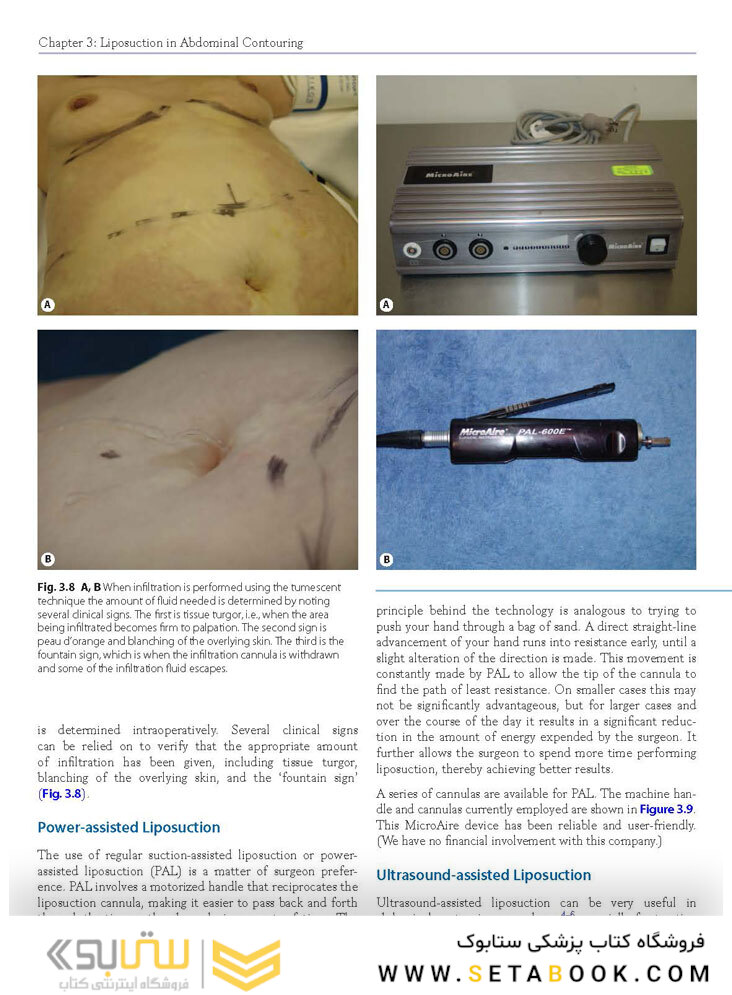 Atlas of Abdominoplasty