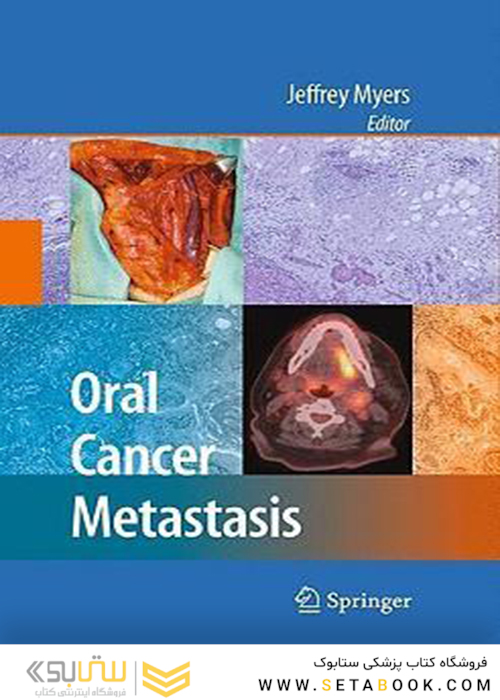 متاستاز سرطان دهان