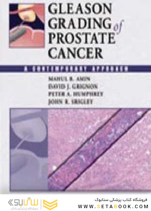 درجه بندی سرطان پروستات