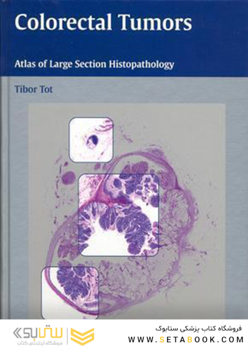 تومورهای کولورکتال