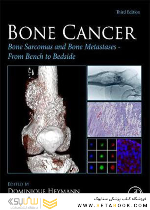 سرطان استخوان