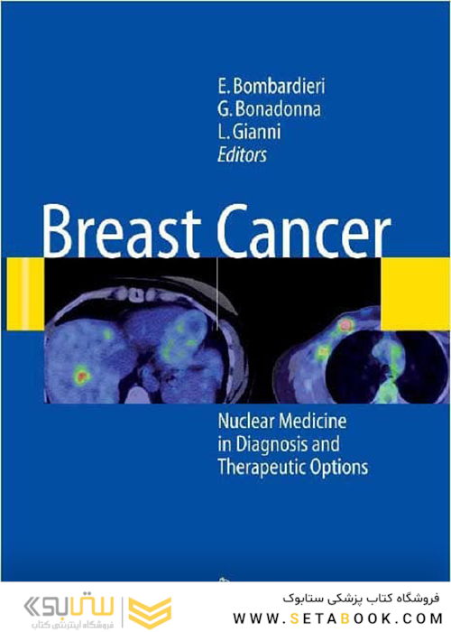 سرطان پستان