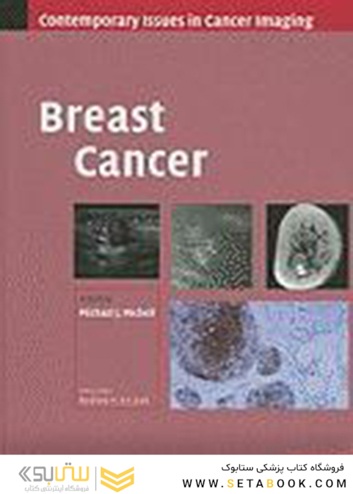 سرطان پستان