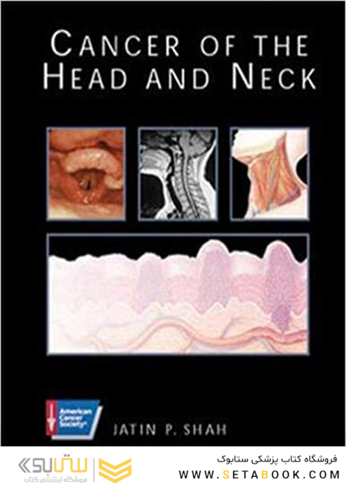 سرطان سر و گردن