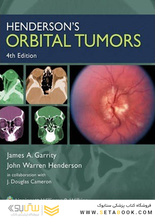 تومورهای مداری هندرسون