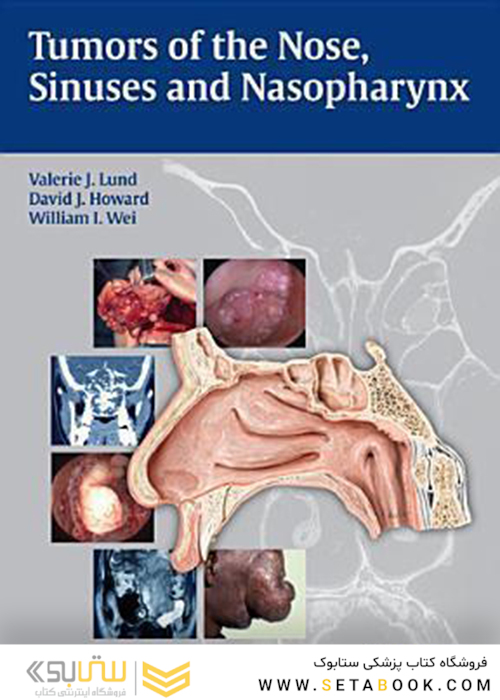 تومورهای بینی، سینوس ها و نازوفارنکس