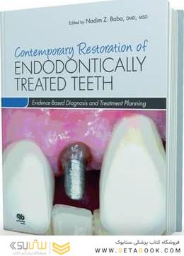 Contemporary Restoration of Endodontically Treated Teeth