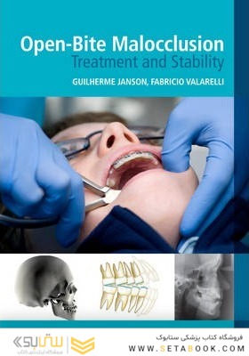 Open-Bite Malocclusion : Treatment and Stability