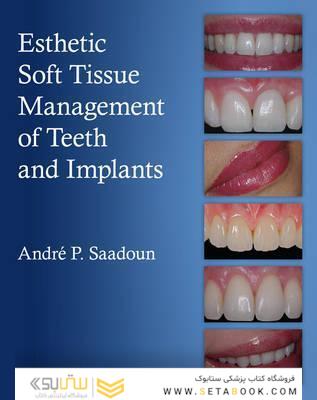 Esthetic Soft Tissue Management of Teeth and Implants