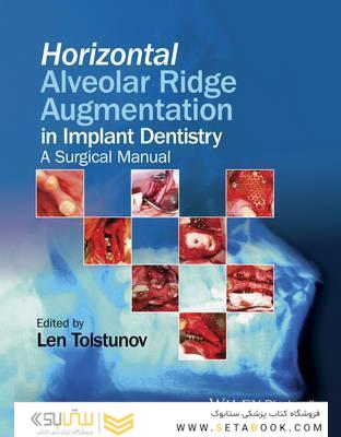 Horizontal Alveolar Ridge Augmentation in Implant Dentistry : A Surgical Manual