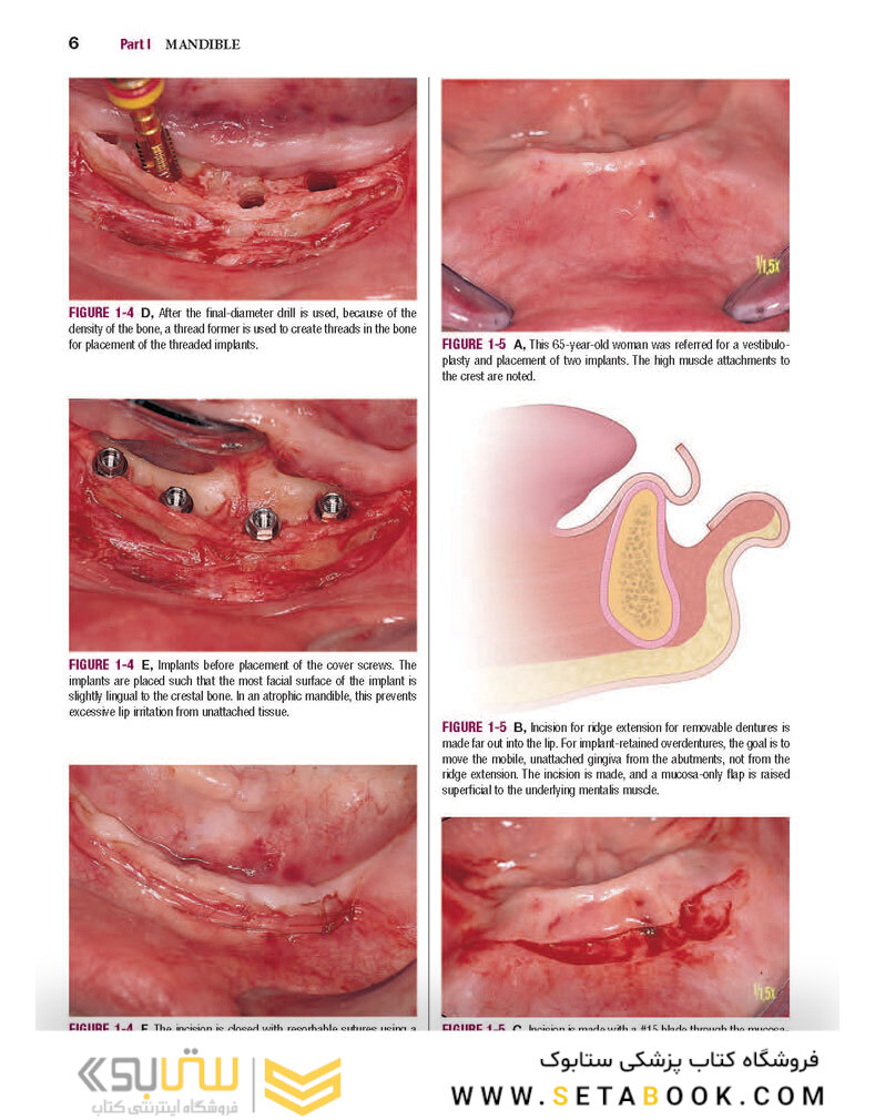 Color Atlas of Dental Implant Surgery 4th Edicion 2015