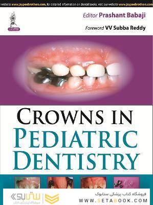 Crowns in Pediatric Dentistry