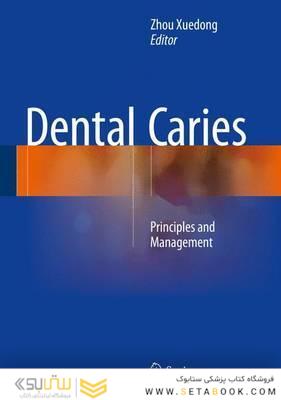 Dental Caries2016
