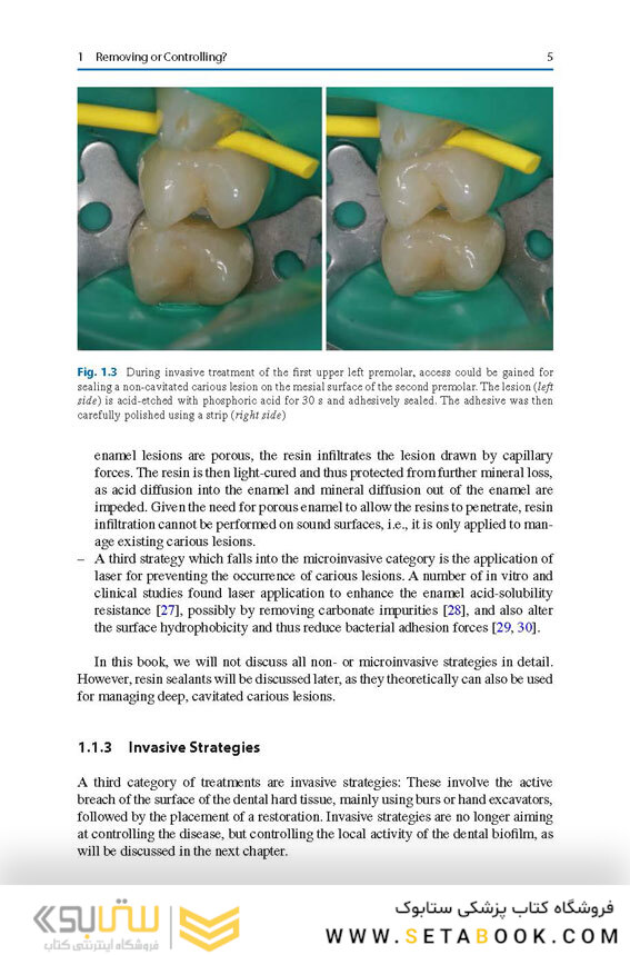Management of Deep Carious Lesions 2018