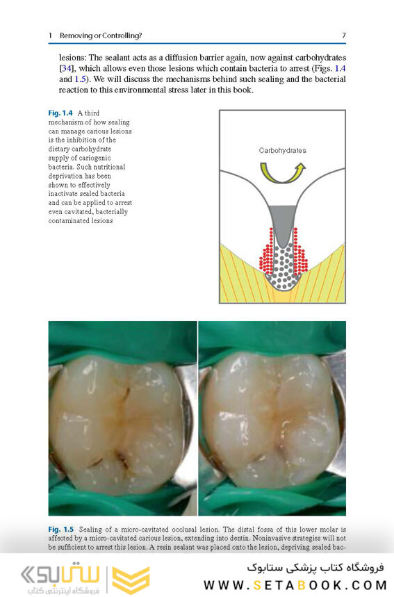 Management of Deep Carious Lesions 2018