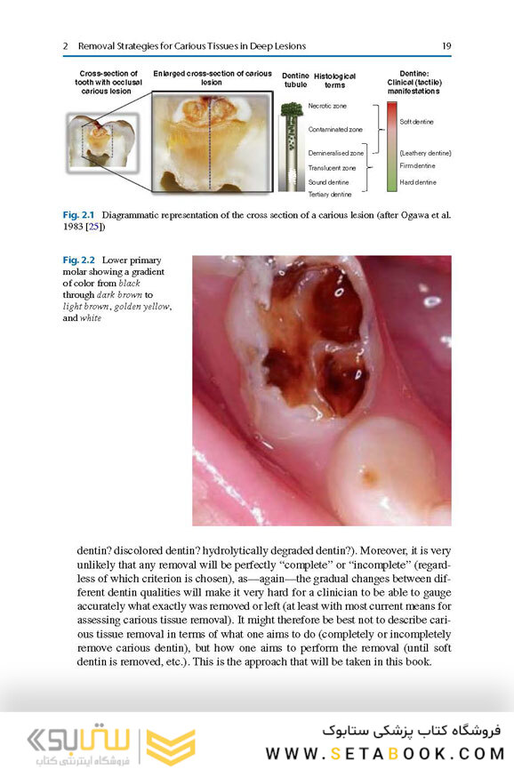 Management of Deep Carious Lesions 2018