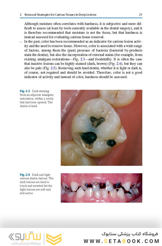 Management of Deep Carious Lesions 2018