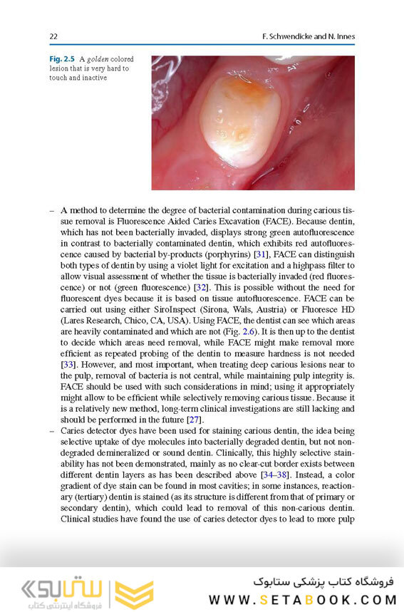 Management of Deep Carious Lesions 2018